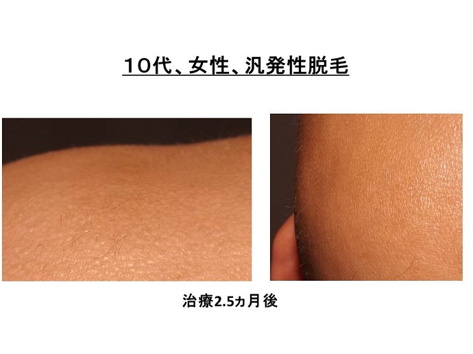 円形脱毛症　病院""